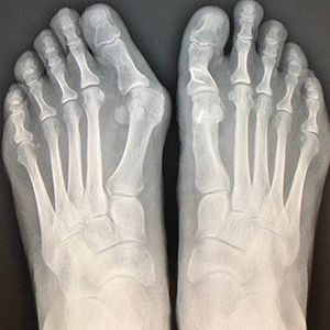 Forefoot surgery