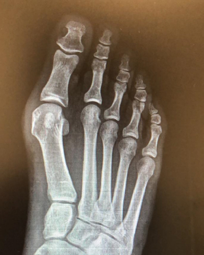 Deformidad de Hallux Valgus