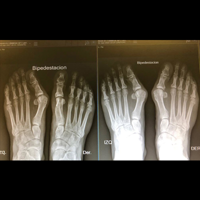 Hallux Valgus surgery